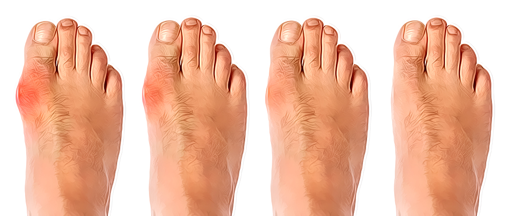 bunion mild to severe